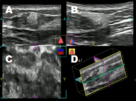正常乳線の超音波像