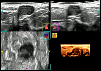 乳線良性腫瘤の超音波像