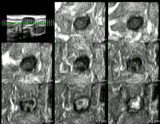 乳線良性腫瘤の水平面の超音波像