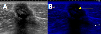 乳線悪性腫瘤の超音波像