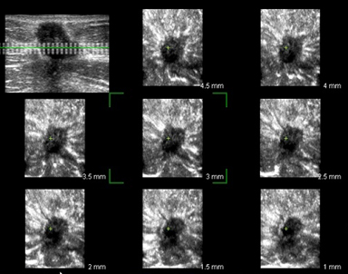 乳線悪性腫瘤の水平面の超音波像