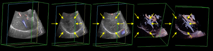 肝臓良性腫瘤の立体構築した超音波像