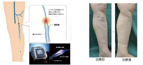 下肢静脈瘤レーザー治療
