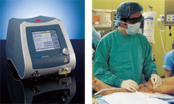 血管内レーザー治療