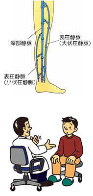 下肢静脈瘤