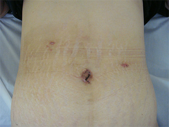 腹腔鏡下胃切除の術創