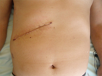 開腹手術での胆嚢摘出術の術創