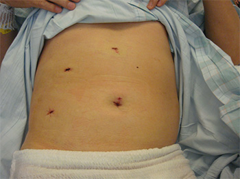 腹腔鏡下胆嚢摘出術　術創の写真