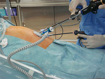 単孔式腹腔鏡手術(胆嚢摘出術)　術中写真