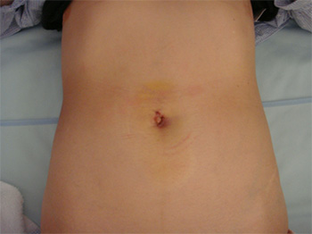 単孔式腹腔鏡下胆嚢摘出術　術創の写真