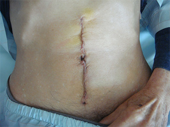 開腹手術による結腸切除　術創の写真