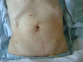 腹腔鏡補助下結腸切除術　術創の写真