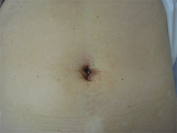 腹腔鏡下虫垂切除術(単孔式)　術創の写真