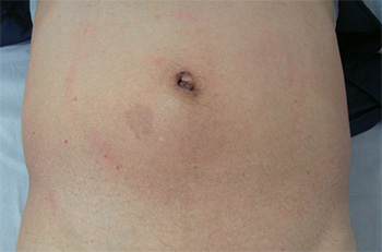 鼠径ヘルニアに対する腹腔鏡下手術の術創