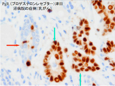 津田沼病院の症例(乳がん)