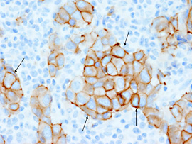 リンパ節に転移したHER2陽性乳がん