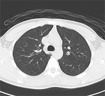 肺ドックのご案内