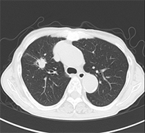 肺ドックのご案内