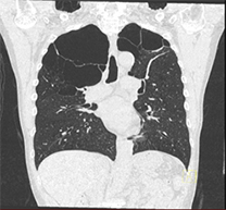 肺ドックのご案内