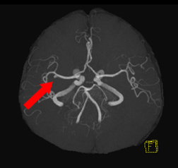 脳ドックのご案内
