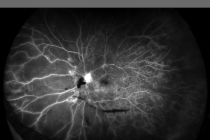 増殖性糖尿病網膜症(FA)